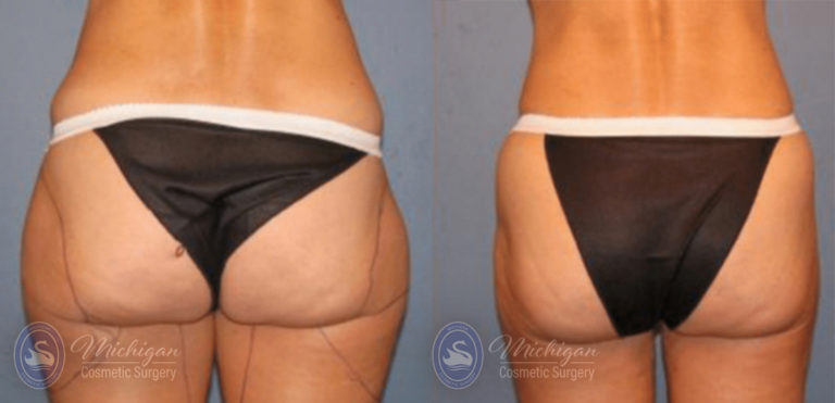 CoolSculpting Before and After Photo by Dr. Awada in Southfield Michigan