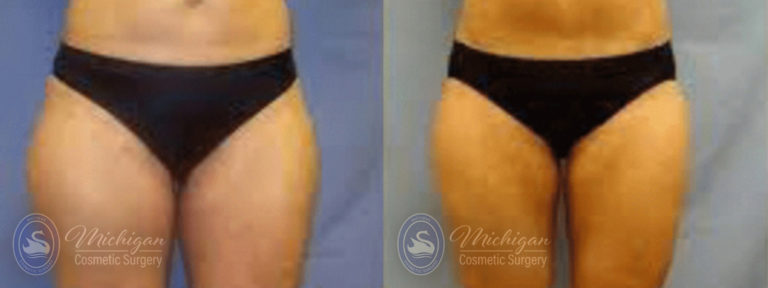 CoolSculpting Before and After Photo by Dr. Awada in Southfield Michigan
