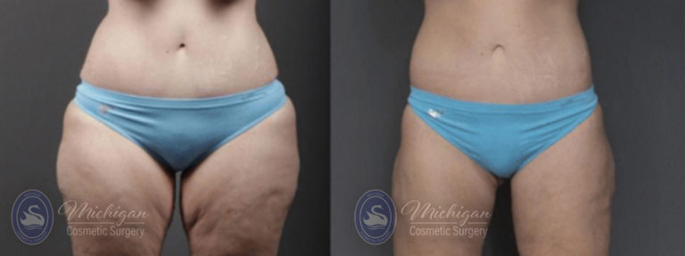 CoolSculpting Before and After Photo by Dr. Awada in Southfield Michigan