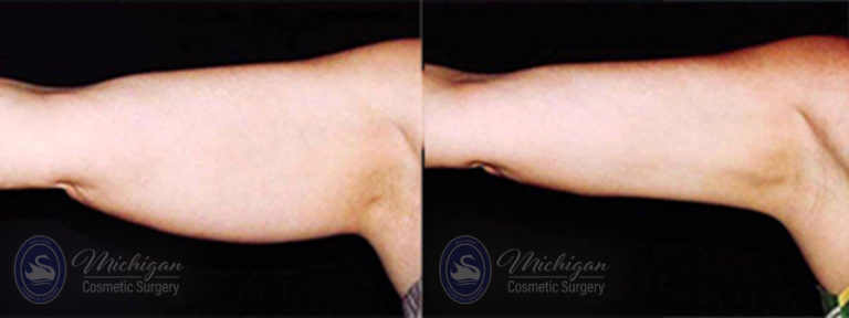 CoolSculpting Before and After Photo by Dr. Awada in Southfield Michigan