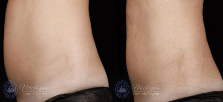CoolSculpting Before and After Photo by Dr. Awada in Southfield Michigan