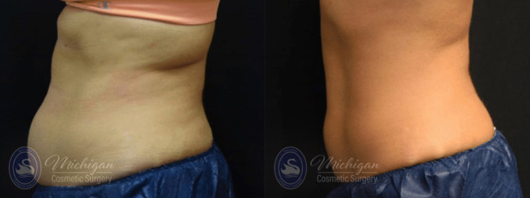 CoolSculpting Before and After Photo by Dr. Awada in Southfield Michigan