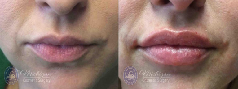 Dermal Fillers Before and After Photo by Dr. Awada in Southfield Michigan