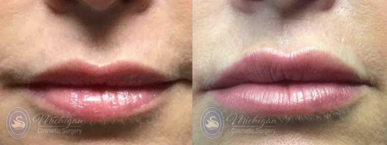 Dermal Fillers Before and After Photo by Dr. Awada in Southfield Michigan