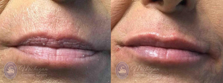 Dermal Fillers Before and After Photo by Dr. Awada in Southfield Michigan