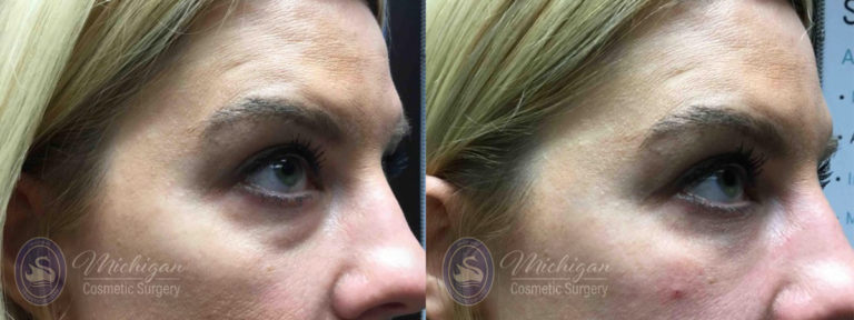 Dermal Fillers Before and After Photo by Dr. Awada in Southfield Michigan