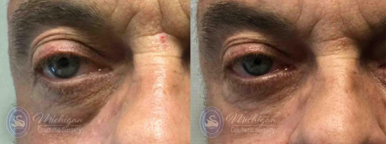 Dermal Fillers Before and After Photo by Dr. Awada in Southfield Michigan
