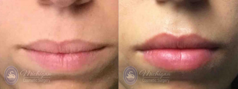 Dermal Fillers Before and After Photo by Dr. Awada in Southfield Michigan