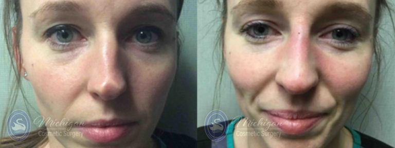 Dermal Fillers Before and After Photo by Dr. Awada in Southfield Michigan