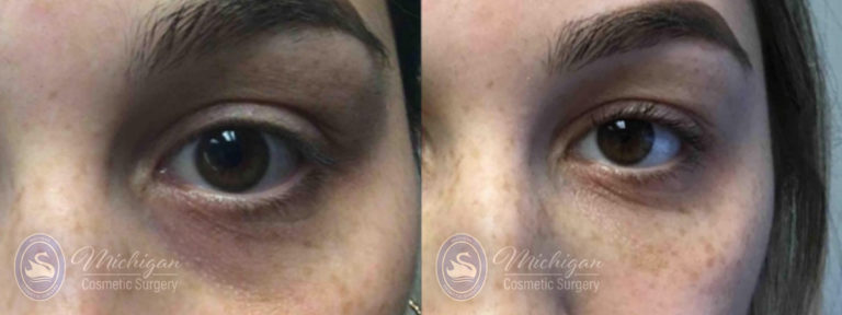 Dermal Fillers Before and After Photo by Dr. Awada in Southfield Michigan