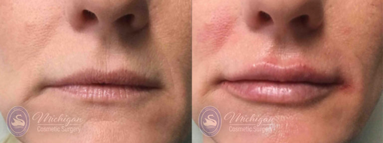 Dermal Fillers Before and After Photo by Dr. Awada in Southfield Michigan