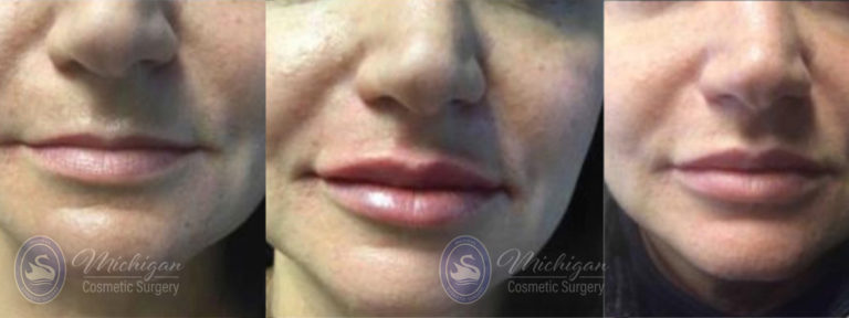 Dermal Fillers Before and After Photo by Dr. Awada in Southfield Michigan