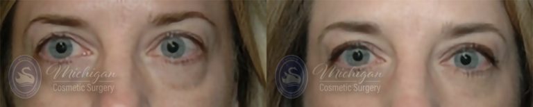 Eyelid Surgery Before and After Photo by Dr. Awada in Southfield Michigan