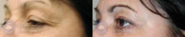 Eyelid Surgery Before and After Photo by Dr. Awada in Southfield Michigan