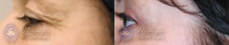 Eyelid Surgery Before and After Photo by Dr. Awada in Southfield Michigan