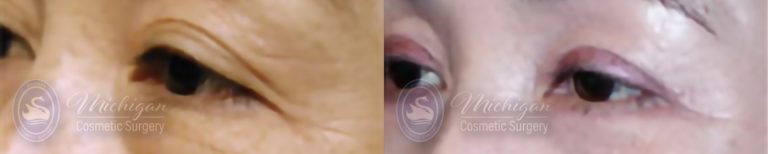 Eyelid Surgery Before and After Photo by Dr. Awada in Southfield Michigan