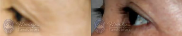 Eyelid Surgery Before and After Photo by Dr. Awada in Southfield Michigan