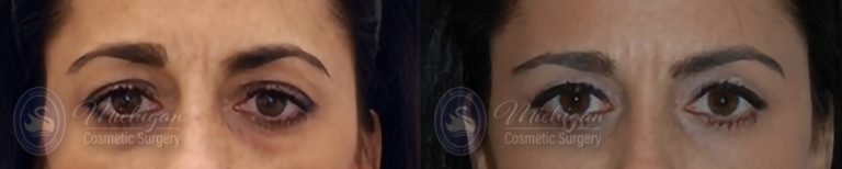 Eyelid Surgery Before and After Photo by Dr. Awada in Southfield Michigan
