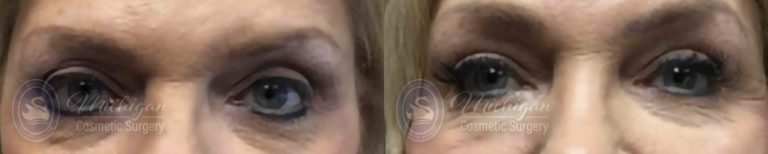 Eyelid Surgery Before and After Photo by Dr. Awada in Southfield Michigan