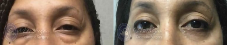 Eyelid Surgery Before and After Photo by Dr. Awada in Southfield Michigan