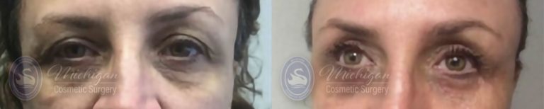 Eyelid Surgery Before and After Photo by Dr. Awada in Southfield Michigan