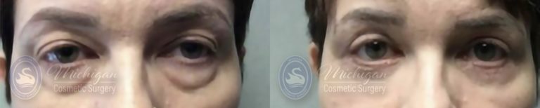 Eyelid Surgery Before and After Photo by Dr. Awada in Southfield Michigan