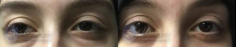 Eyelid Surgery Before and After Photo by Dr. Awada in Southfield Michigan