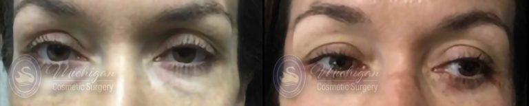 Eyelid Surgery Before and After Photo by Dr. Awada in Southfield Michigan