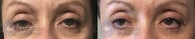 Eyelid Surgery Before and After Photo by Dr. Awada in Southfield Michigan