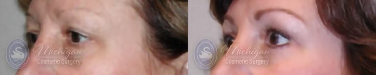 Eyelid Surgery Before and After Photo by Dr. Awada in Southfield Michigan
