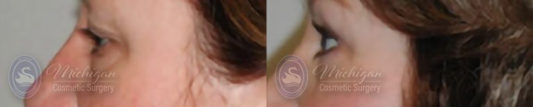 Eyelid Surgery Before and After Photo by Dr. Awada in Southfield Michigan