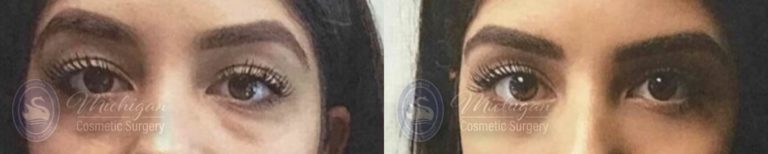 Eyelid Surgery Before and After Photo by Dr. Awada in Southfield Michigan