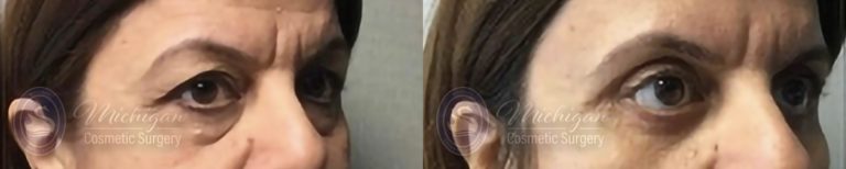 Eyelid Surgery Before and After Photo by Dr. Awada in Southfield Michigan