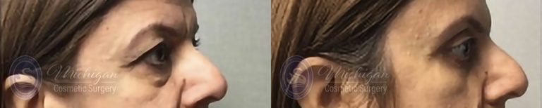 Eyelid Surgery Before and After Photo by Dr. Awada in Southfield Michigan
