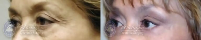 Eyelid Surgery Before and After Photo by Dr. Awada in Southfield Michigan