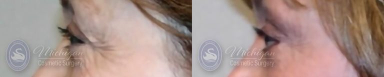 Eyelid Surgery Before and After Photo by Dr. Awada in Southfield Michigan