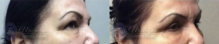 Eyelid Surgery Before and After Photo by Dr. Awada in Southfield Michigan