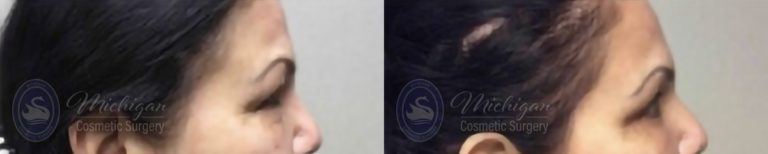 Eyelid Surgery Before and After Photo by Dr. Awada in Southfield Michigan