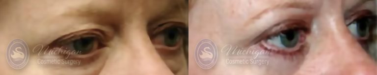 Eyelid Surgery Before and After Photo by Dr. Awada in Southfield Michigan