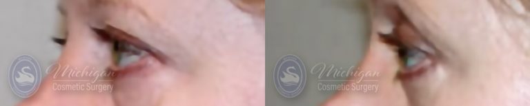 Eyelid Surgery Before and After Photo by Dr. Awada in Southfield Michigan