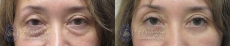 Eyelid Surgery Before and After Photo by Dr. Awada in Southfield Michigan