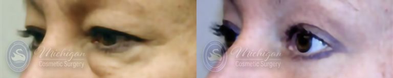 Eyelid Surgery Before and After Photo by Dr. Awada in Southfield Michigan