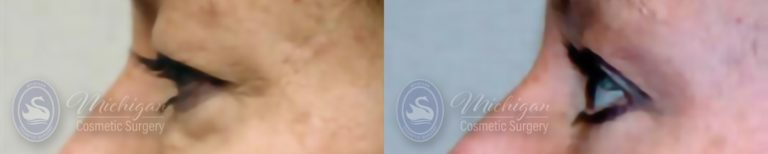 Eyelid Surgery Before and After Photo by Dr. Awada in Southfield Michigan