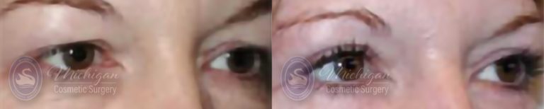 Eyelid Surgery Before and After Photo by Dr. Awada in Southfield Michigan