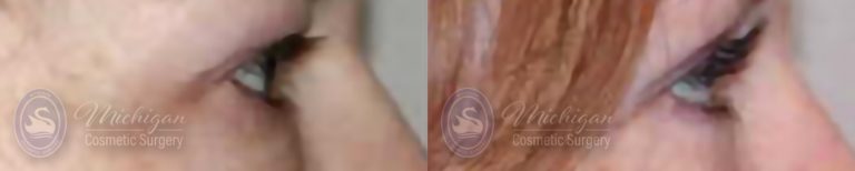 Eyelid Surgery Before and After Photo by Dr. Awada in Southfield Michigan
