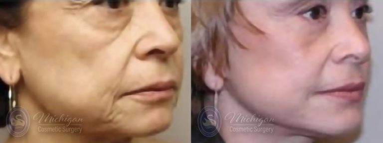 Facelift/Necklift Before and After Photo by Dr. Awada in Southfield Michigan