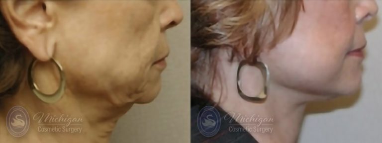 Facelift/Necklift Before and After Photo by Dr. Awada in Southfield Michigan