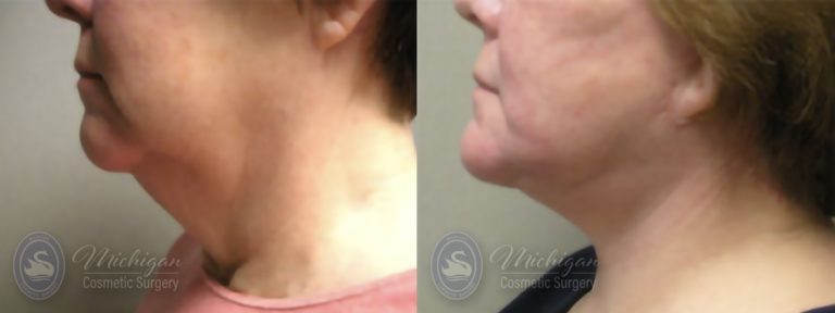 Facelift/Necklift Before and After Photo by Dr. Awada in Southfield Michigan