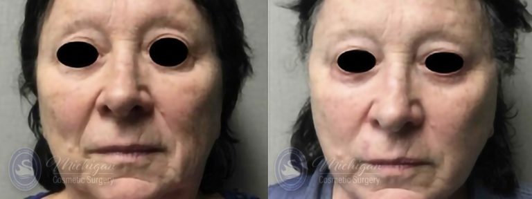 Facelift/Necklift Before and After Photo by Dr. Awada in Southfield Michigan