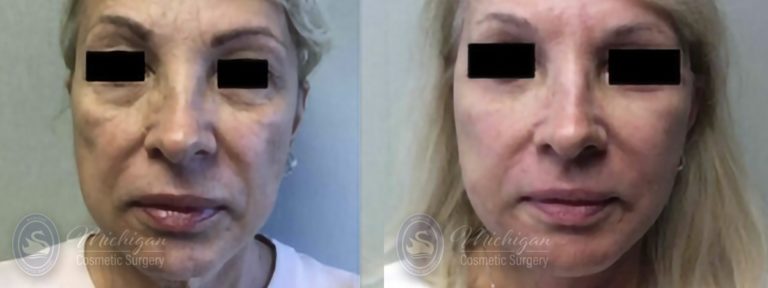 Facelift/Necklift Before and After Photo by Dr. Awada in Southfield Michigan